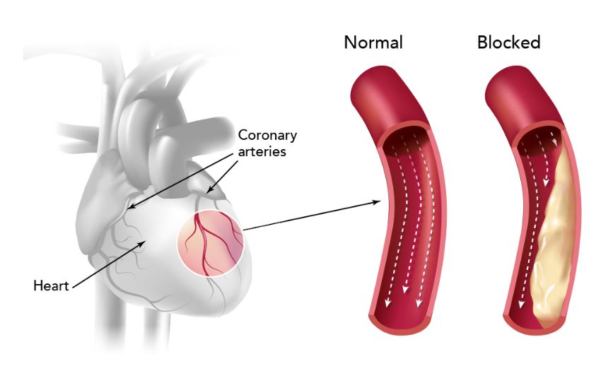 Heart Blockage